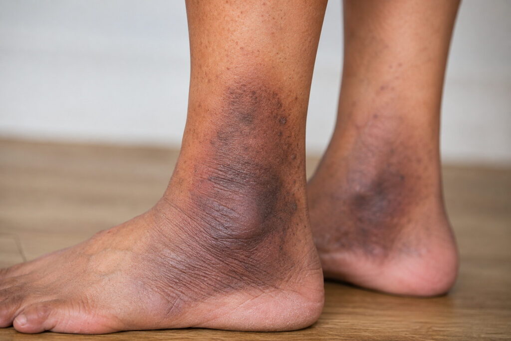 Dark Skin Around the Ankles? It May Be a Vein Condition