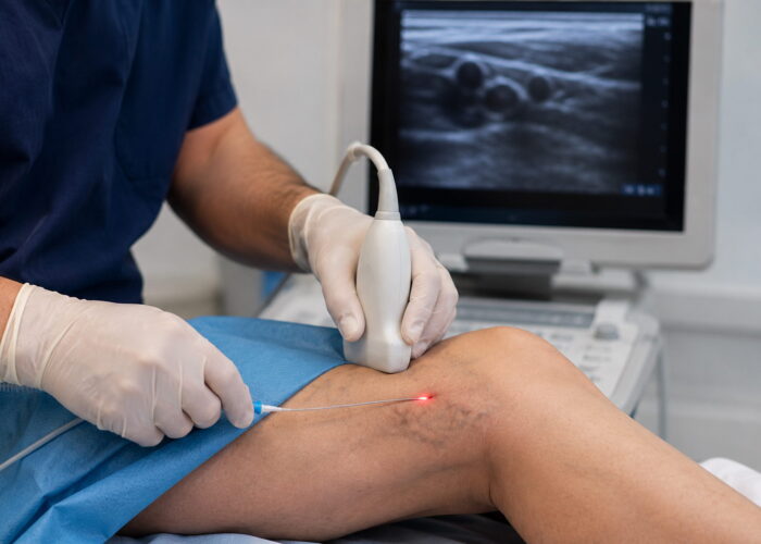How Radiofrequency Ablation Treats Varicose Veins Without Surgery